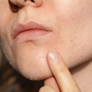 DRY SKIN