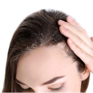 HAIR DANDRUFF